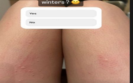 Urfi Javed suffering from this serious disease, shared the video and said - That's why she does not wear full clothes