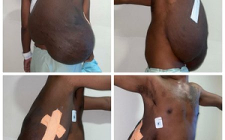 10 घंटे की सर्जरी के बाद व्यक्ति की पीठ से निकाला गया 16.7 किलो का ट्यूमर